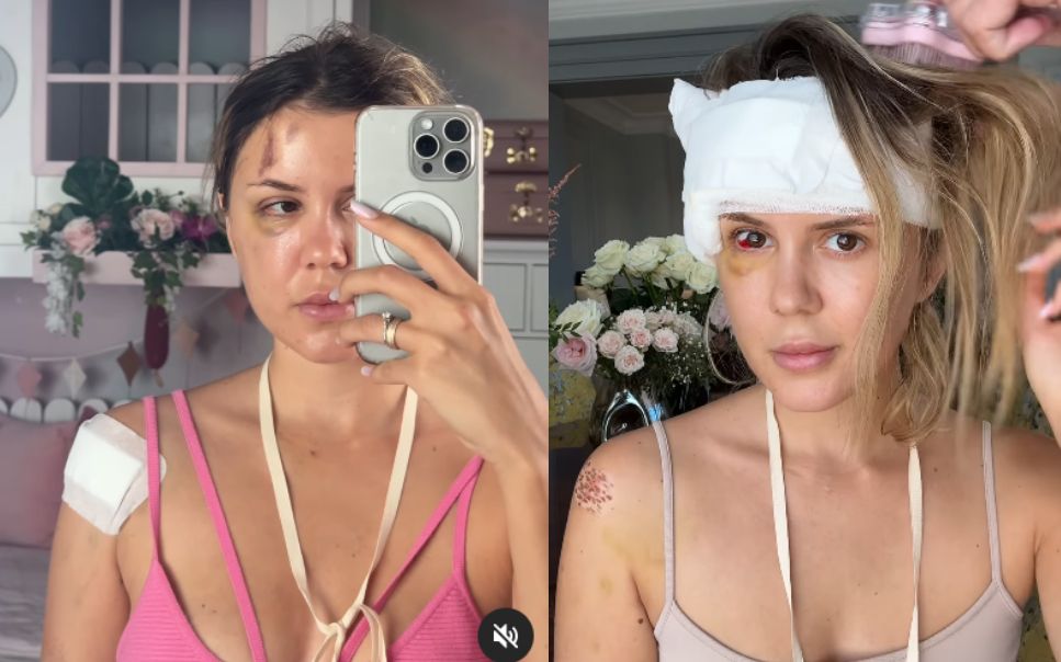 Semnificația panglicii pe care Emily Burghelea o poartă &icirc;n fiecare zi la g&acirc;t, de c&acirc;nd a fost la doar un pas de a-și pierde viața, &icirc;n urma accidentului rutier din Mauritius: &bdquo;Am multă recunoștință&rdquo;